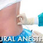 Epidural-Anesthesia