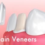 Porcelain Veneers