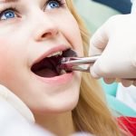 Tooth extractions