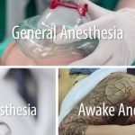 Types Of Anesthesia