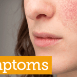 lupus-symptoms