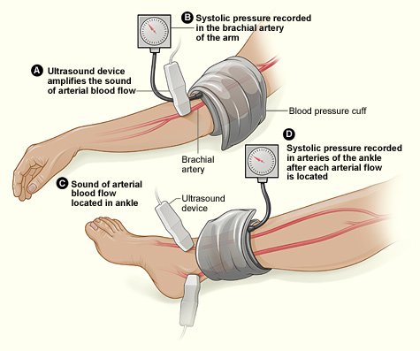 The ankle-brachial index (ABI) test.