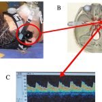 Transcranial Ultrasound