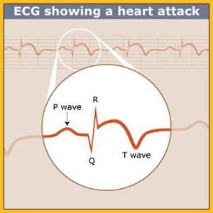 ecg-heart attack