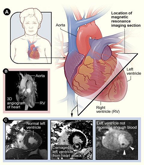 hf-diagnosis-mri-images-nhlbi