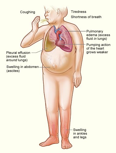 hf-symptoms-nhlbi